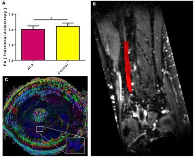 MRI DTI and PDFF as Biomarkers for Lower Motor Neuron Degeneration in ALS